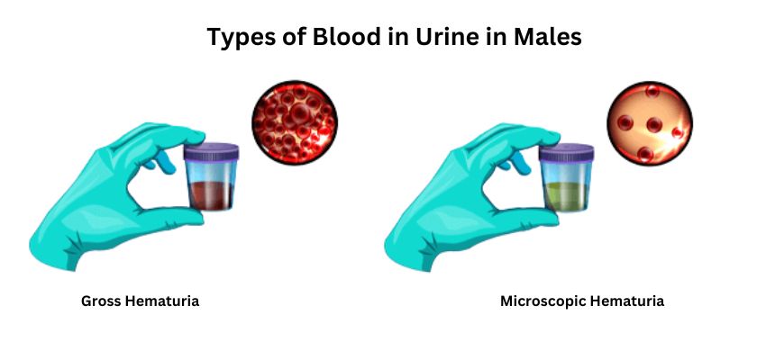  Blood in Urine in Males