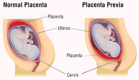 Causes for Placenta previa