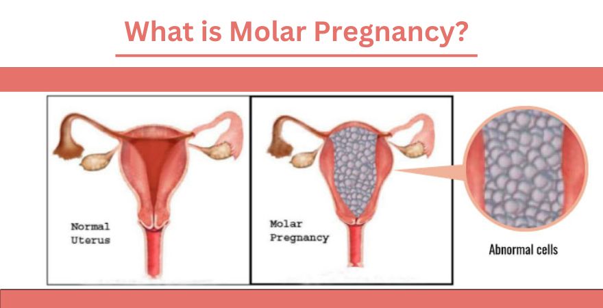 Molar Pregnancy in Hindi